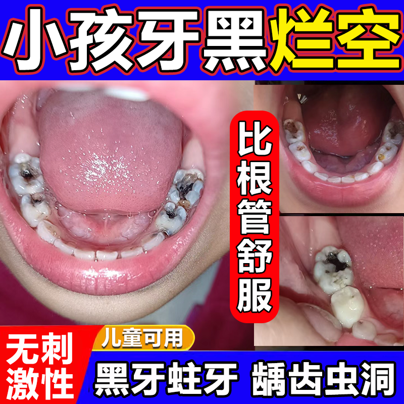 防蛀膏牙龋齿蛀牙洞
