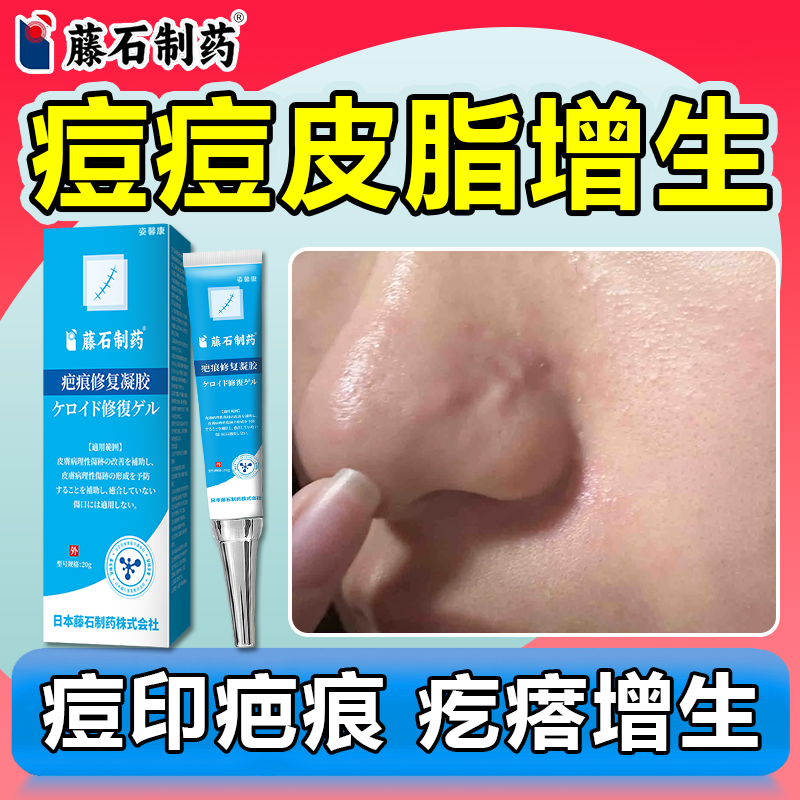 去鼻子痘痘疤痕疙瘩增生凝胶