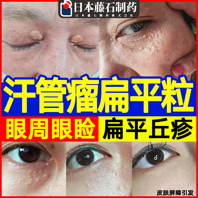 日本监制【汗管瘤软膏】