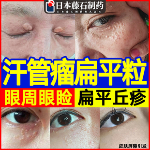 汗管瘤眼部眼角脂肪粒扁平疣睑黄瘤专搭去用除药监神备案器膏xj