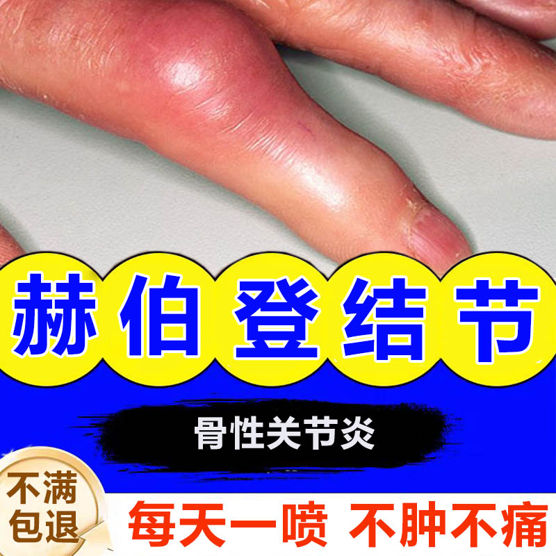 手指肿大赫伯登结节特类风湿关节炎效搭中药帖痛风关节疼痛疙瘩mf