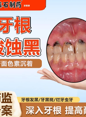 牙齿酸蚀黑斑修可乐牙釉质脱矿损伤去除复牙齿敏感蛀牙美白牙膏wg