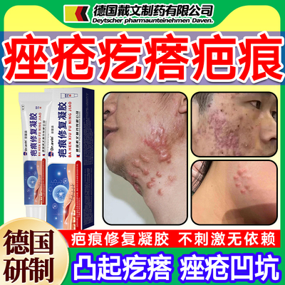 痤疮痘印痘坑疤痕去增生瘢痕凸起去除疙瘩修硬肉止痒祛疤痕复膏xj