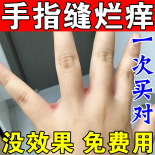 手指缝溃烂痒泛红开裂口经常碰水烂手丫脱皮水泡痒修复专用药软膏