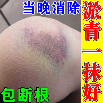 撞伤摔伤淤青快速消除活血化瘀外用淤青膏发紫散淤消肿止痛活络油