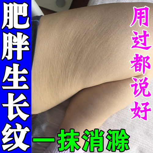 去除肥胖纹生长纹修复霜消除大腿内侧肥胖纹路紧致淡化妊娠纹药膏