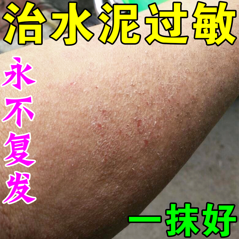 水泥过敏止痒药建筑专用胳膊瘙痒手痒干裂脱皮起水泡真菌感染药膏