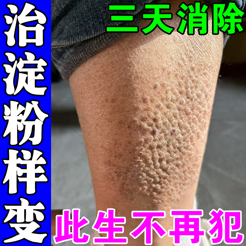 皮肤淀粉样变专用药治疗顽固胳膊小腿粗糙疙瘩痒凸起小颗粒黑色素