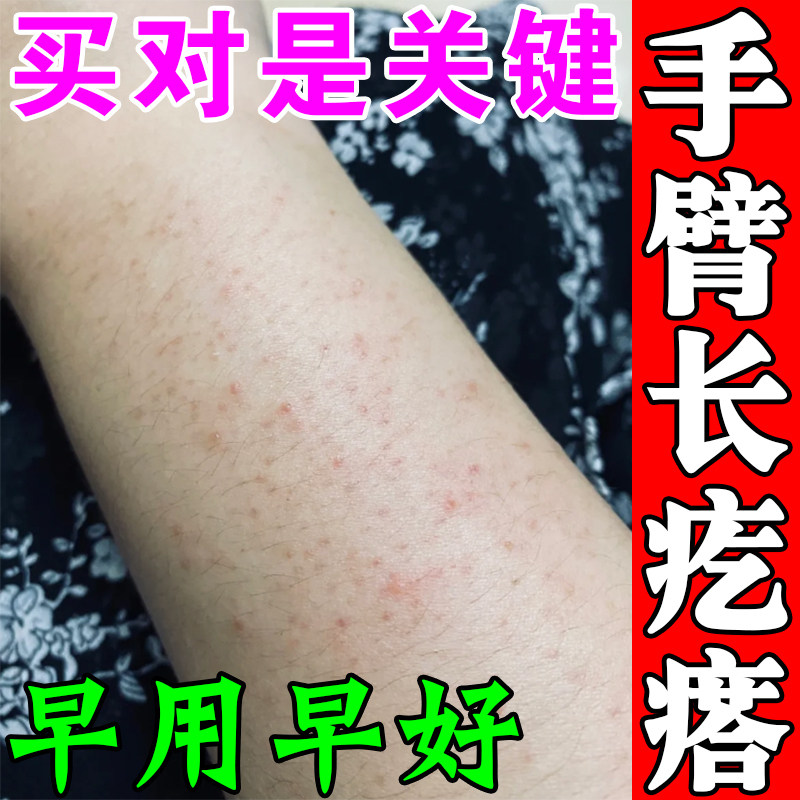 胳膊长小红疙瘩去除手臂炎毛囊鸡皮肤疙瘩毛周角化小颗粒痒药专用