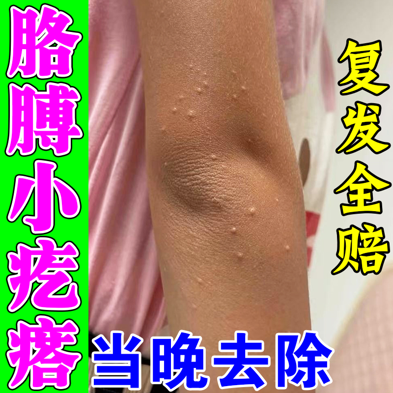 去除胳膊上长小疙瘩痘痘手臂毛囊炎脸上小颗粒鸡皮肤毛囊角化药膏