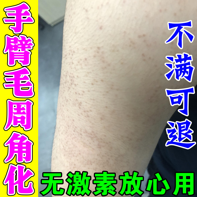 手臂鸡皮肤疙瘩炎毛囊毛周角化症去胳膊上的小疙瘩颗粒黑红点膏药