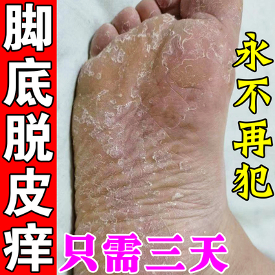 脚掌脱皮脚底脚心掉皮脱皮专用药脚痒皮肤粗糙干燥干裂脚痒抑菌膏