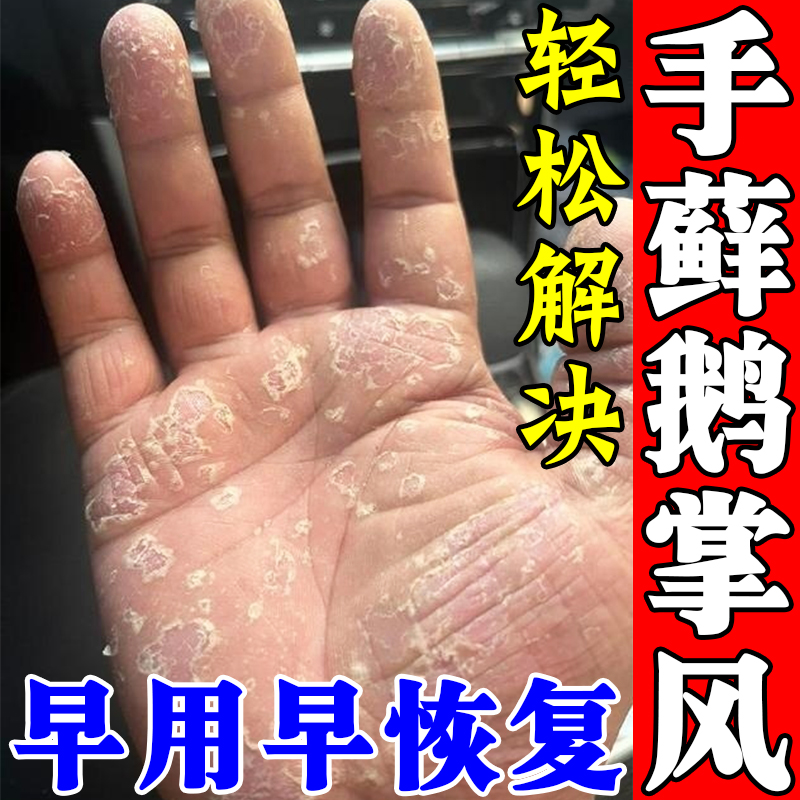 鹅掌风专用手藓癣膏药治疗手掌干开裂脱皮痒手指头蜕皮起硬皮药膏