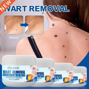 Wart Remover Safe Painless Skin Tags Removal Ointment Fast
