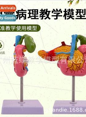 Medical Pancreas Duodenum Gallbladder Pathology Model Gallst