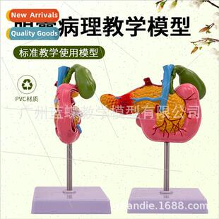 Medical Pancreas Duodenum Gallbladder Pathology Model Gallst