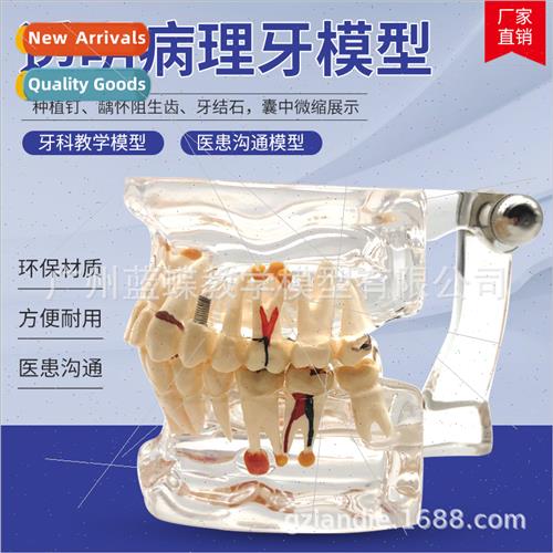Transparent Full Mouth Pathology Dental Medical Teaching Com