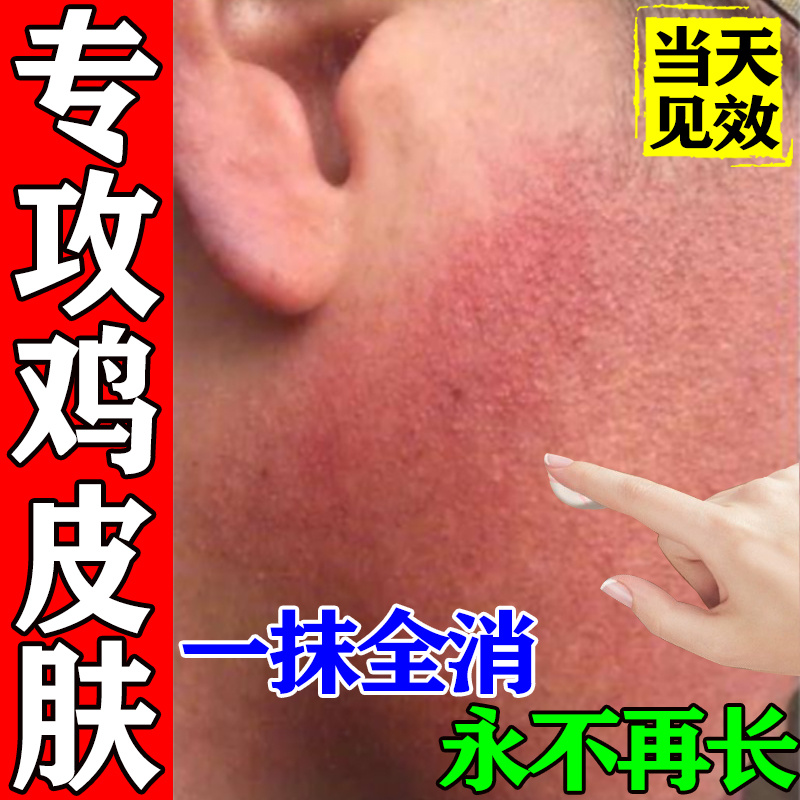 鸡皮肤疙瘩毛囊角化药膏毛周角化症儿童脸部手臂腿上疙瘩去除神器