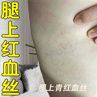 腿上红血丝毛细血管扩张青筋凸起酸麻胀痛红血丝