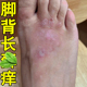 脚背长疙瘩脚面起红疙瘩脚杆脚出汗脚面长红斑小红点外用软膏药