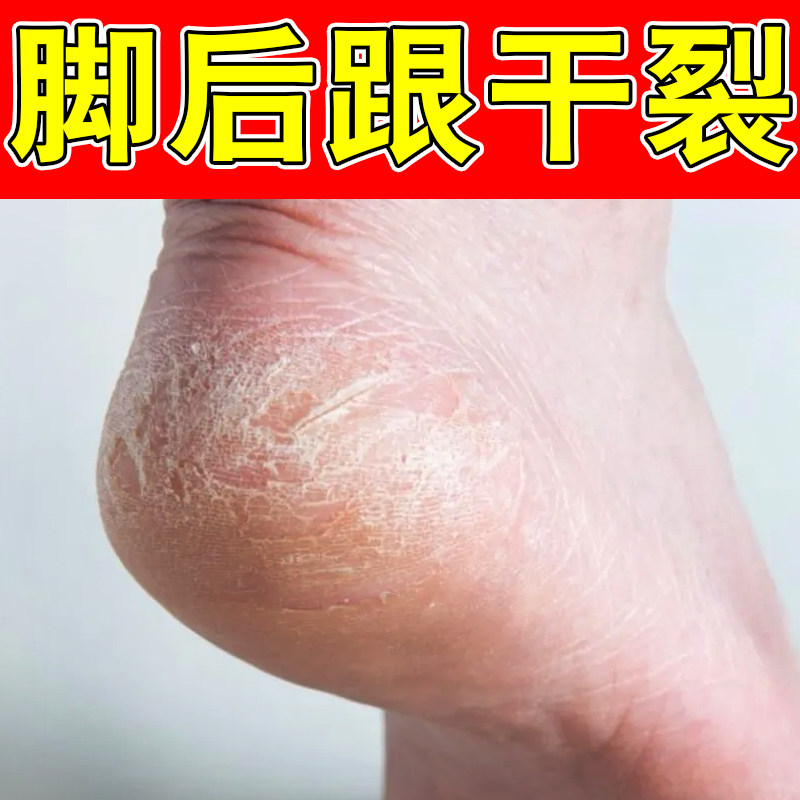 脚后跟裂口干燥起硬皮冶足跟干裂专冶手脚起皮掉屑脱皮外用修复霜