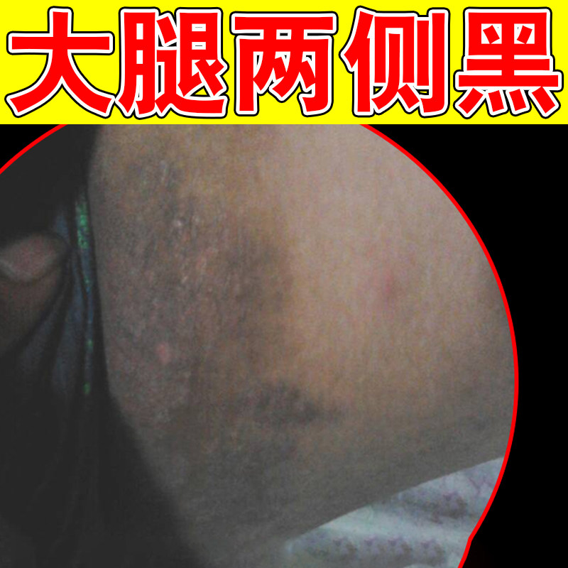 去大腿内侧黑色素沉淀除屁股坐印黑腋下手肘关节脖子胳膊肘黑棘皮