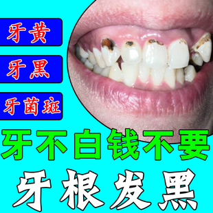 牙根发黑牙窝沟牙菌斑牙缝发黑牙齿变白黄牙齿黑线黑渍