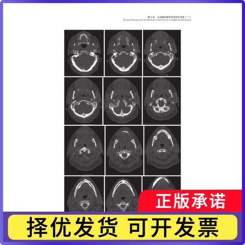 放肿瘤学急与晚期毒的防治:放肿瘤学中的毒管理:management of toxicities in radiation oncology