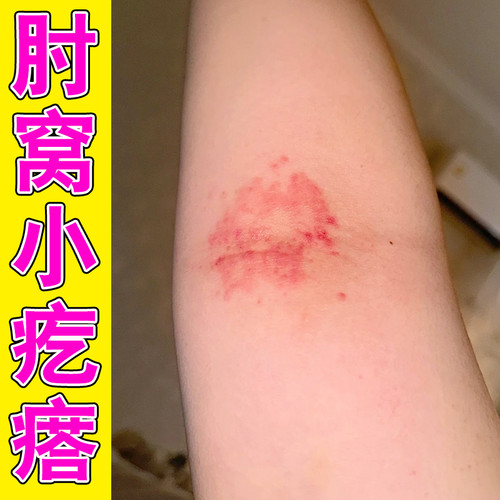 胳膊肘窝湿起小红点疙瘩干燥胳膊肘窝内侧起红肿疙瘩乳膏