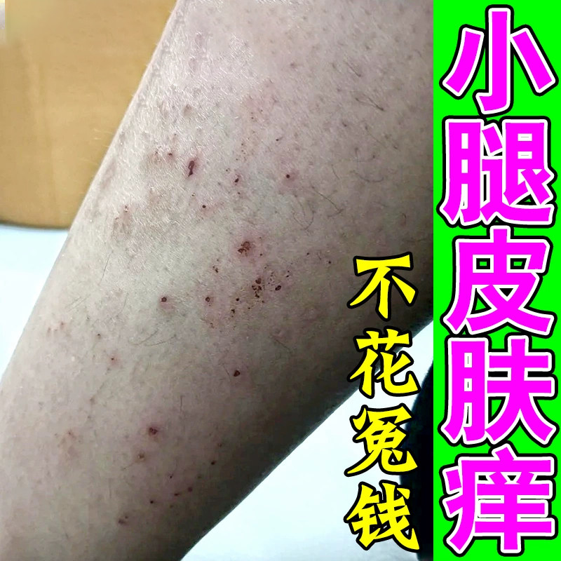 冬天腿换季腿上过敏起红点干长疙瘩身上起皮掉屑外用软膏,保健用品,皮肤消毒护理（消）,淘宝优惠券,粉丝福利购,淘宝优惠卷