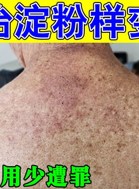 皮肤淀粉样变专用冶疗顽固后背黑色素皮肤粗糙小颗粒苔小腿乳膏