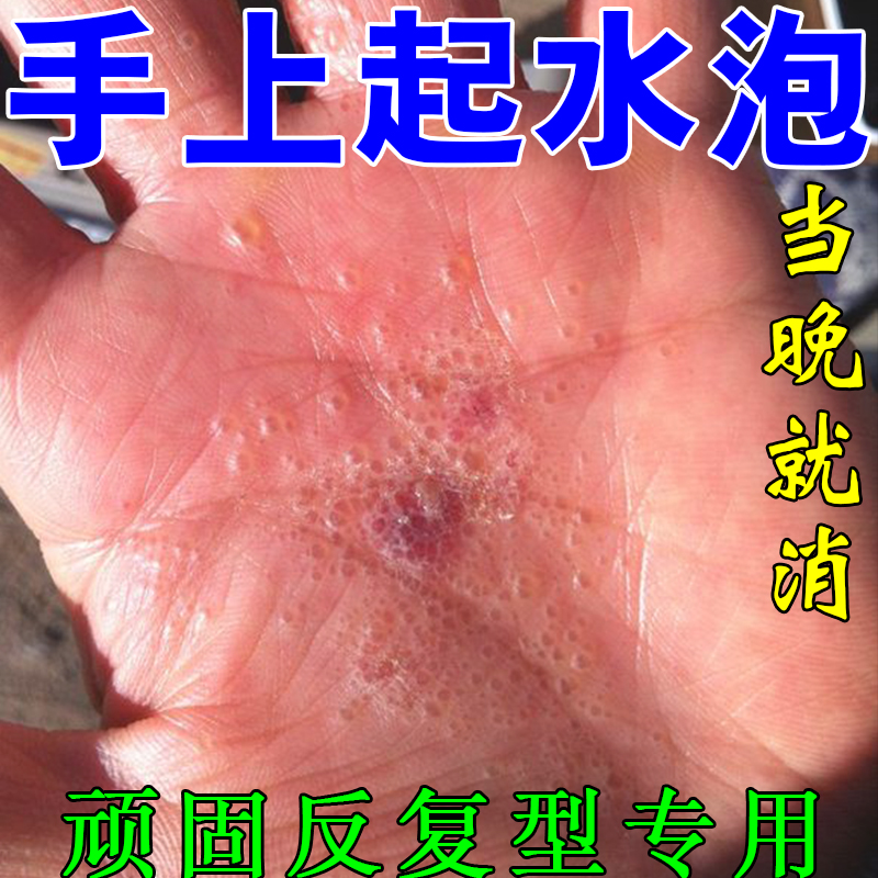 手上起小水泡专用药膏手癣湿疹干裂牛皮癣银屑病汗疱疹皮肤瘙痒膏
