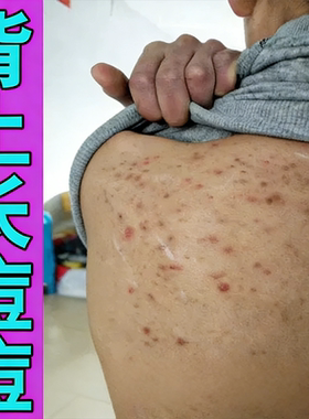 背后豆背上长豆前胸后背起红肿小疙瘩男女学生