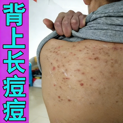 背后豆背上长豆前胸后背起红肿小疙瘩男女学生