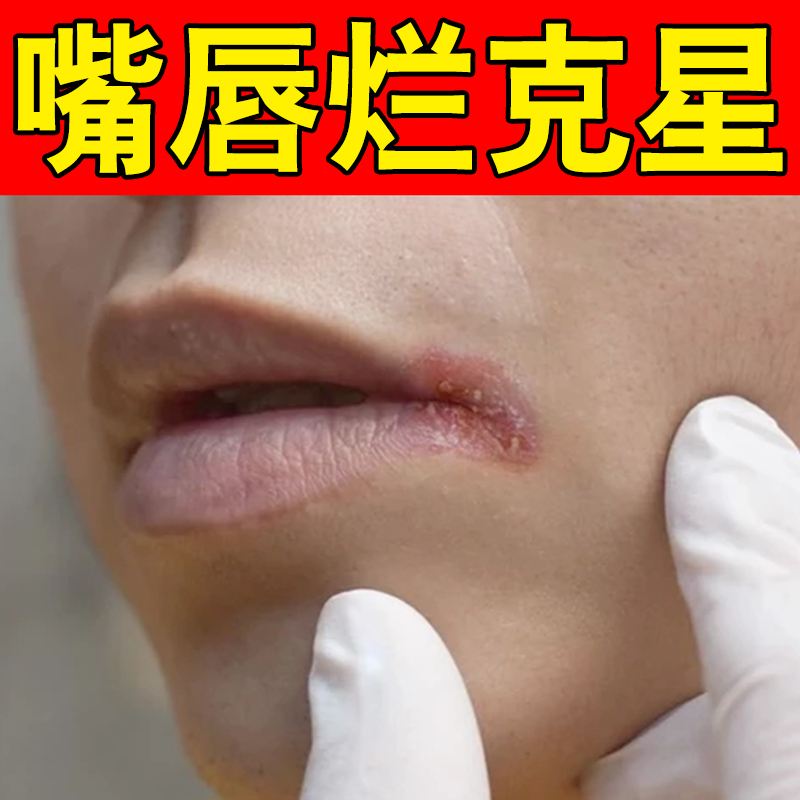 儿童唇炎口角炎嘴角开裂烂嘴角嘴唇干裂脱皮上火起泡溃烂裂口专用