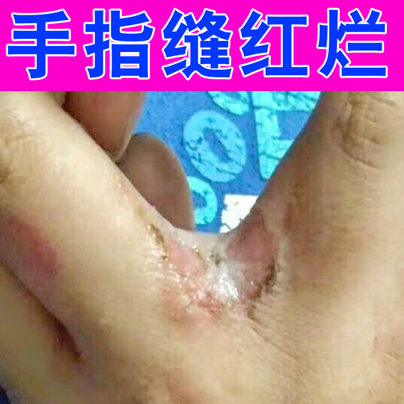 手指缝溃烂指间开裂发红发痒干燥脱皮手丫专用乳膏