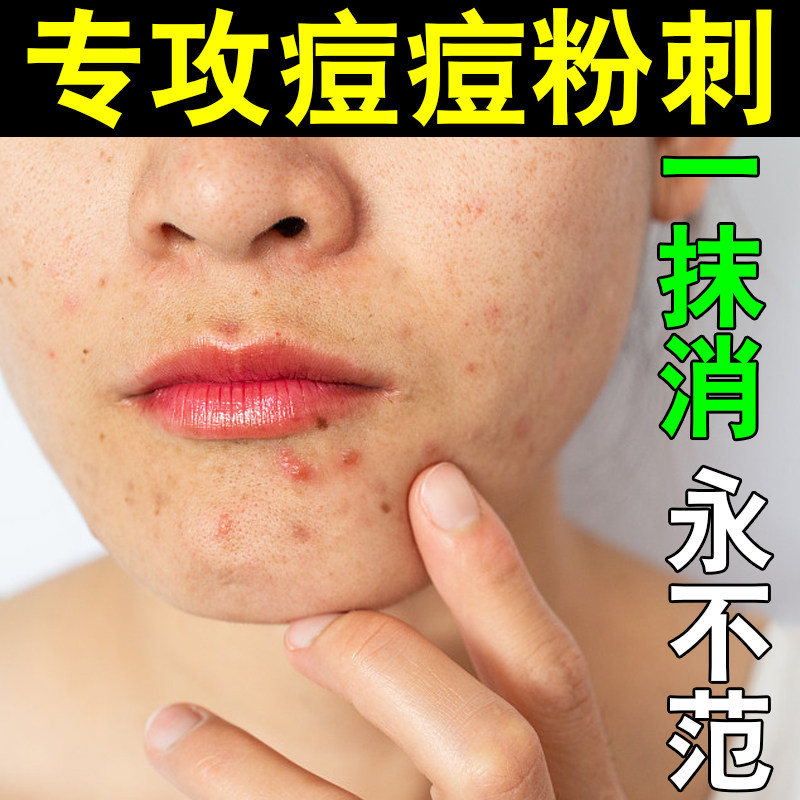 脸上长痘痘用什么药祛痘膏消炎祛痘红肿熬夜祛痘膏腮边痘硬块痘