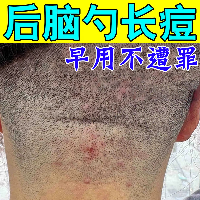 头上长痘痘毛囊炎软膏专用后脑勺毛囊堵塞起脓包疙瘩红肿头皮痒