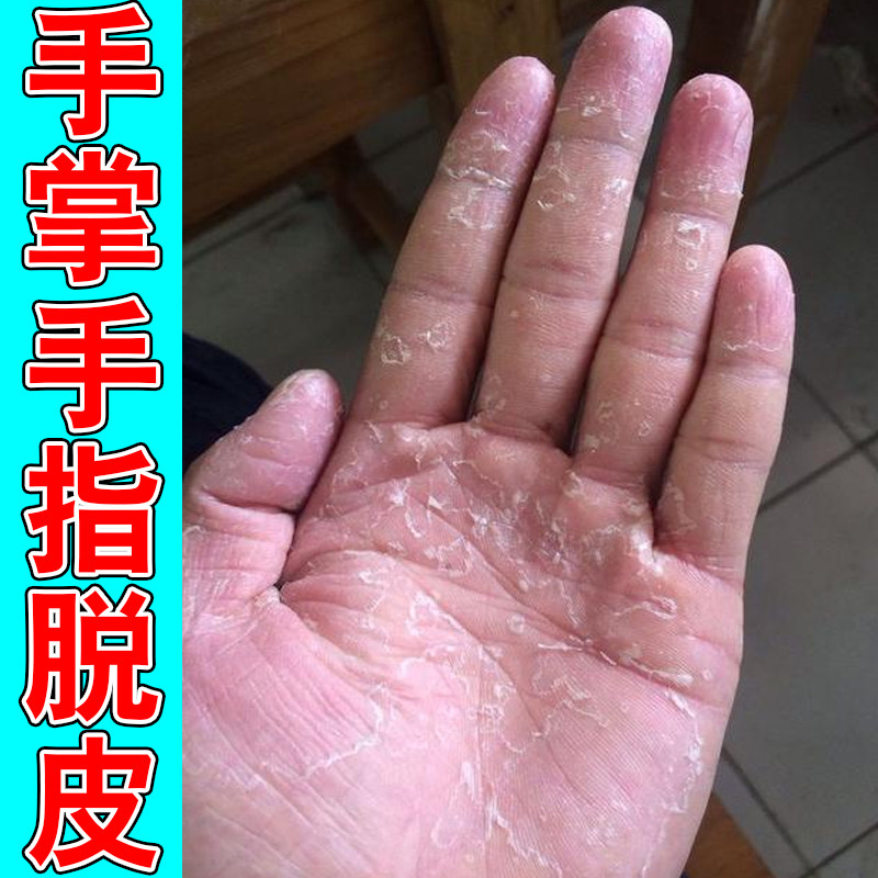 手掌手指脱皮起皮干燥粗糙换季手皮肤消毒护理（消）