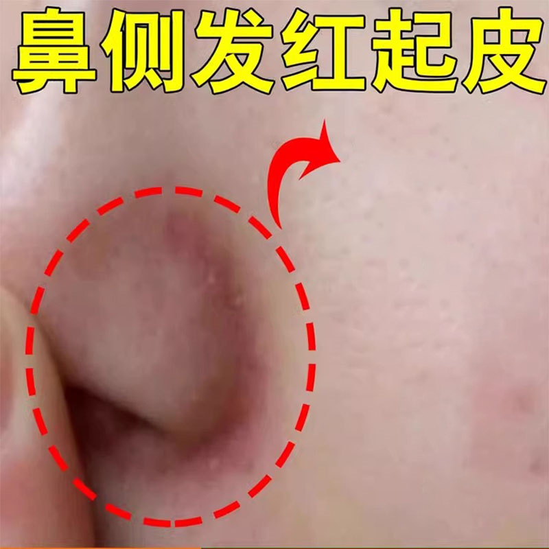 鼻子两侧发红油腻脱皮掉皮脂溢性专药用鼻翼两边泛红干燥起皮软膏