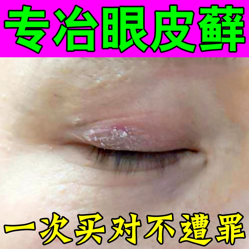 眼皮痒红肿发痒上眼皮红肿痒眼睛周围干痒发痒皱巴巴干燥起干皮膏