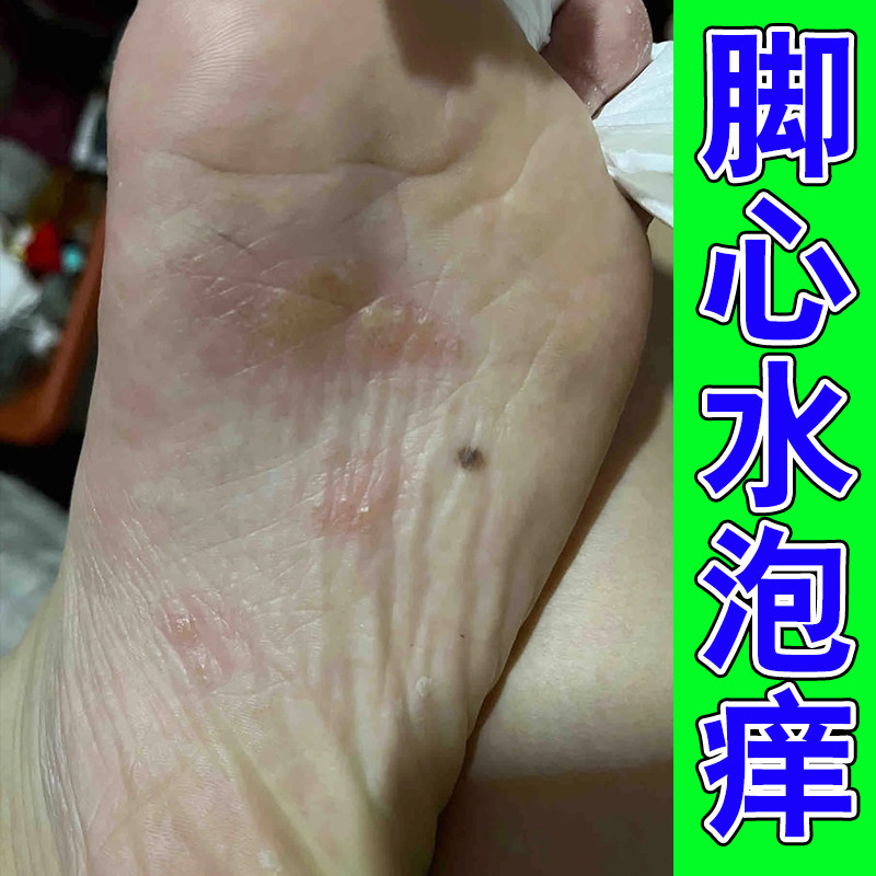脚底上起泡又脱皮冶脚心脚掌心起皮肤消毒护理（消）