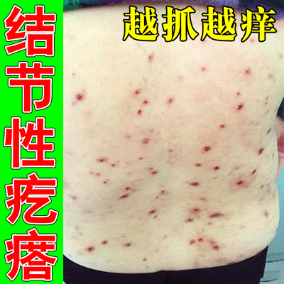 身上长疙瘩后背身上痒起疙瘩丘小点蚊虫叮咬软膏