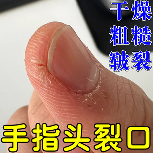 手指头裂口子干燥粗糙疼痛秋冬天指甲缝开裂疼痛手干裂修复霜