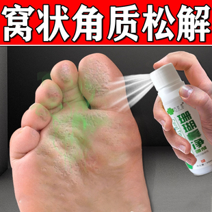 窝状角质松解脚底起泡蜂窝状沙虫脚脚出汗脚底脚心发白