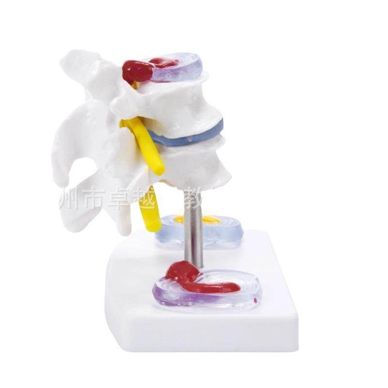 病变腰椎模型人体腰椎间盆突出模型二节病理脊椎模型骨科模型,文具电教/文化用品/商务用品,教学标本/模型,淘宝优惠券,粉丝福利购,淘宝优惠卷