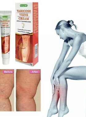 New Varicose Veins Ointmnet Vasculitis Phlebitis Spider