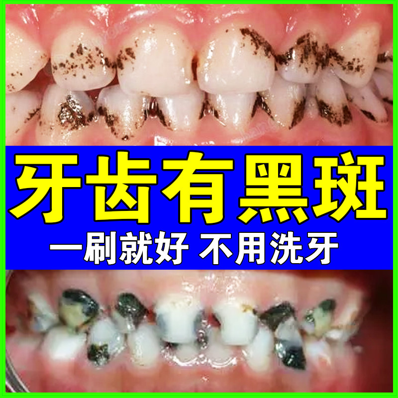 牙齿黑斑去除牙膏去牙菌斑黑线黑渍牙窝沟清洁蛀牙菌斑牙缝发黑