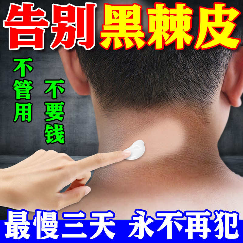 脖子黑黑的黑棘皮症去除脖子黑色素沉淀洗不干净肥胖儿童美白神器