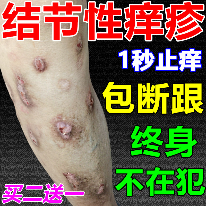 结节性痒疹治顽固硬疙瘩全身皮肤皮肤消毒护理（消）